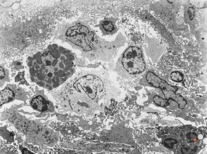 F,32y. | lymphadenopathy - clin. dysglobulinaemia